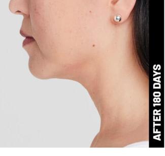 Ultherapy Before & After Patient #1546